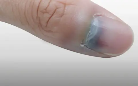 Gros plan sur un pouce avec un ongle bleu, signe d'un choc ou d'une ecchymose sous l'ongle.