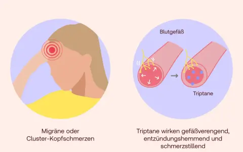 Triptane helfen bei Migräne, indem sie Blutgefäße verengen, Entzündungen hemmen und Schmerzen lindern.