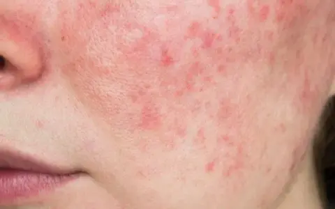 Gerötete Gesichtshaut: Ursachen, Symptome und effektive Behandlungsmöglichkeiten