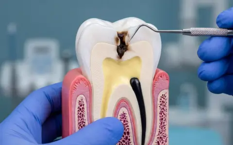 Model zęba pokazuje zaawansowaną próchnicę, która dotarła do miazgi. Dentysta w niebieskiej rękawiczce bada ubytek.