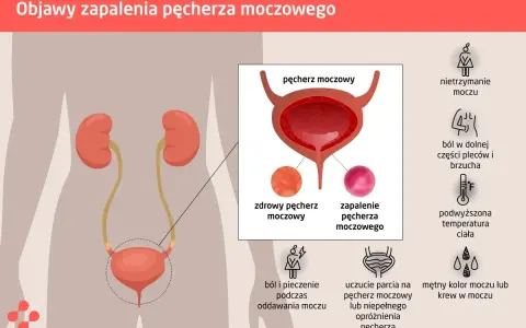 Ból i pieczenie przy oddawaniu moczu to jeden z objawów zapalenia pęcherza. Grafika pokazuje układ moczowy i objawy infekcji.