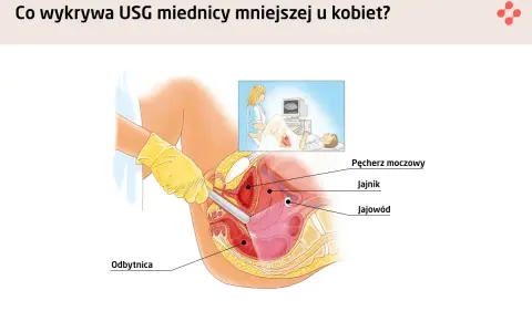 Ilustracja pokazuje, jak wygląda macica podczas badania USG. Widoczne są pęcherz moczowy, jajnik, jajowód i odbytnica.