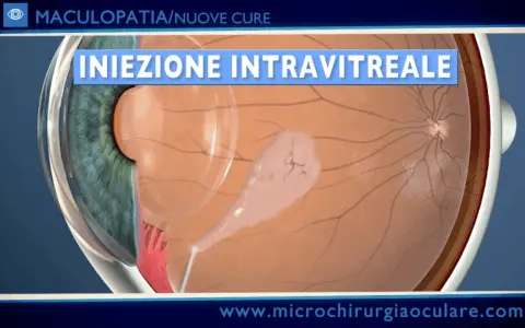 Iniezione intravitreale per trattare la maculopatia atrofica, mostrando una lesione sulla retina.