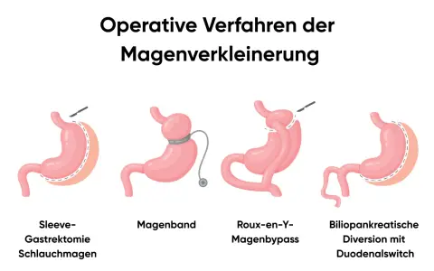 Illustrationen zeigen operative Verfahren zur Magenverkleinerung, darunter ein Magenbypass.