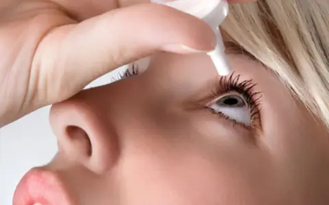 Persona applica collirio per trattare l'edema corneale post cataratta, alleviando i sintomi.