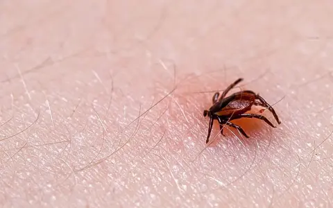 Makro zbliżenie na kleszcza wbitego w ludzką skórę, widoczne drobne włoski i tekstura naskórka.
