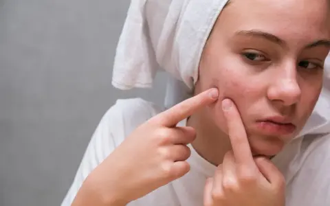 Ropny pryszcz: Jak szybko i skutecznie się go pozbyć? Poradnik