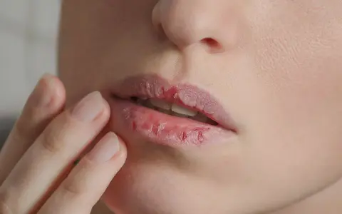 Nahaufnahme von trockenen, rissigen Lippen, die nach Feuchtigkeit verlangen.