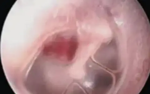 Widok błony bębenkowej z zaczerwienieniem i obrzękiem, wskazujący na zapalenie ucha.