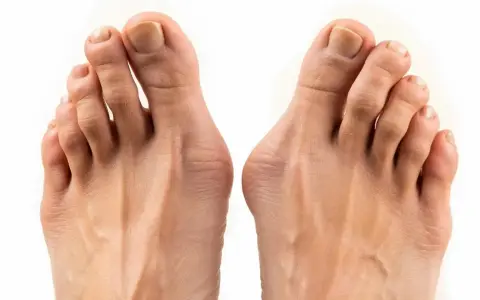 Två fötter med tydlig hallux valgus inflammation vid stortålederna.