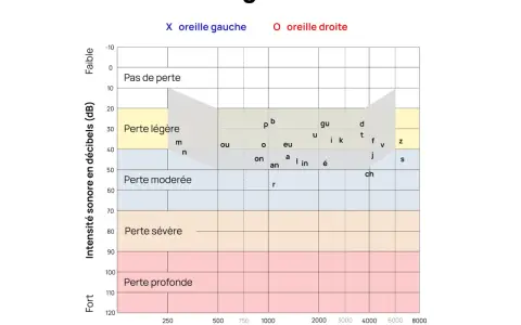 Audiogramme montrant les résultats d'un test auditif. Les zones indiquent le niveau de perte auditive, de "Pas de perte" à "Perte profonde", en fonction de la fréquence et de l'intensité sonore. Ce graphique est essentiel pour évaluer l'audition à tout...
