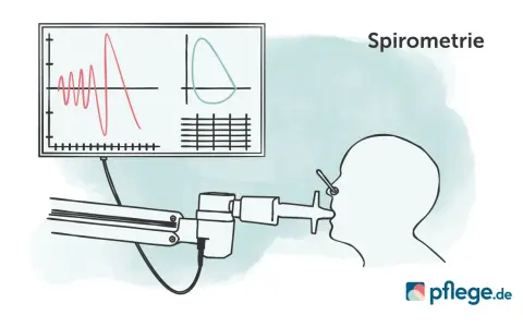 Spirometrie-Diagramm zeigt Lungenfunktion. Wichtig für COPD Gold 3 Rente.