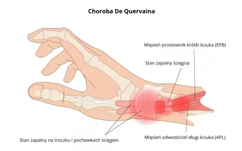 Ilustracja pokazuje chorobę De Quervaina, zapalenie ścięgien kciuka (EPB i APL) oraz pochewek ścięgnistych.
