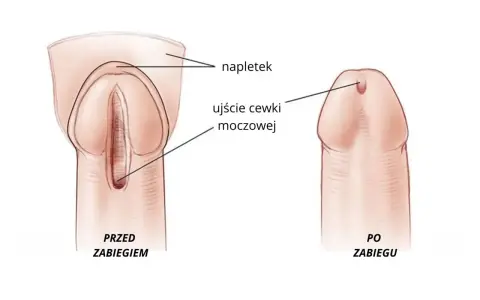 Przed i po zabiegu: ujście cewki moczowej u mężczyzn, z napletkiem.