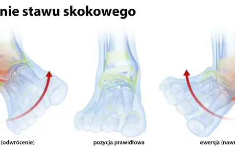 Ilustracja pokazuje inwersję stopy, czyli odwrócenie, które prowadzi do uszkodzenia więzadła skokowo-strzałkowego. Obok prawidłowa pozycja i ewersja.