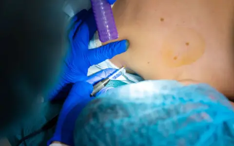 Lekarz pobiera próbkę tkanki. Czy biopsja oznacza raka? Nie zawsze, to ważny krok diagnostyczny.