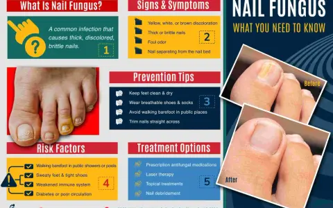 Infographie sur le vernis mycose : causes, symptômes, prévention et traitements. Avant/après montrant l'amélioration d'un ongle atteint.