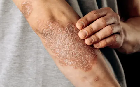 Psoriasis en los codos, con parches escamosos y enrojecidos. Una mano toca suavemente la piel afectada.