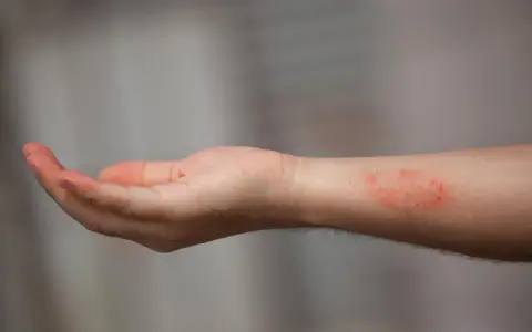 Poignet présentant une dartre cutanée rouge et irritée.