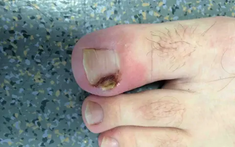 Gros plan sur un ongle de pied présentant un problème d'infection fongique, avec une partie de l'ongle décolorée et abîmée.