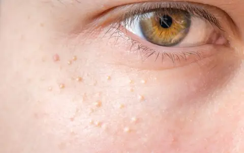 Nahaufnahme der Haut mit kleinen, hellen Erhebungen, die nicht komedogen sind. Das Auge ist im Hintergrund zu sehen.