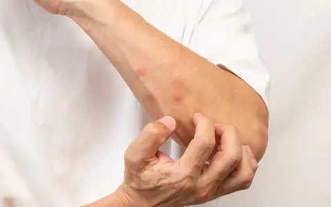 Un bras couvert de boutons rouges, la personne se gratte pour savoir comment ne pas se gratter les boutons de moustiques.