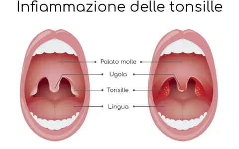 Illustrazione che mostra un'infiammazione delle tonsille, comune nel mal di gola dei bambini. Le tonsille gonfie e rosse sono visibili.