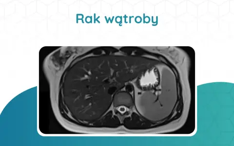 Przekrój tomografii komputerowej wątroby z widocznym guzem.