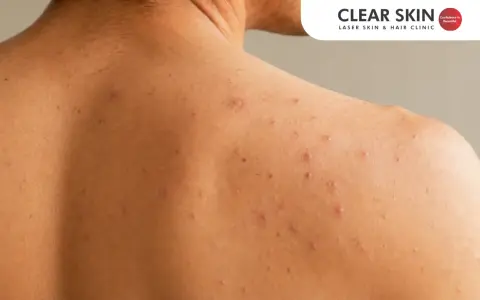 Close-up of shoulder acne. Learn how to get rid of shoulder acne overnight for clearer skin.