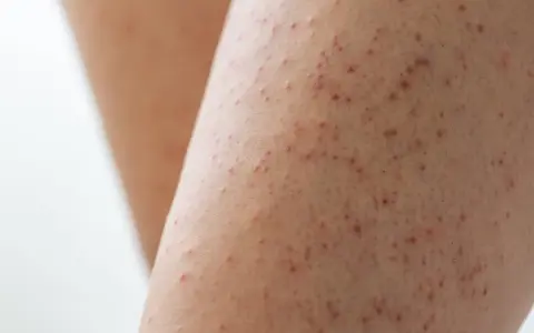 Gros plan sur une peau présentant des petites bosses rouges, typiques de la kératose pilaire.