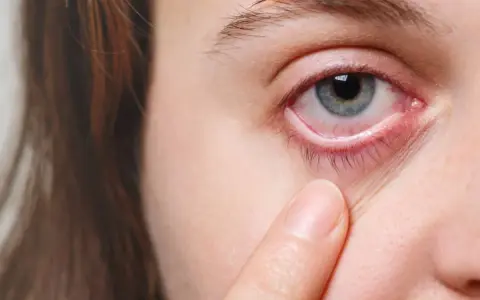 Occhi rossi e lacrimanti, forse per un'allergia o stanchezza. Un dito sfiora la palpebra inferiore, evidenziando il disagio.