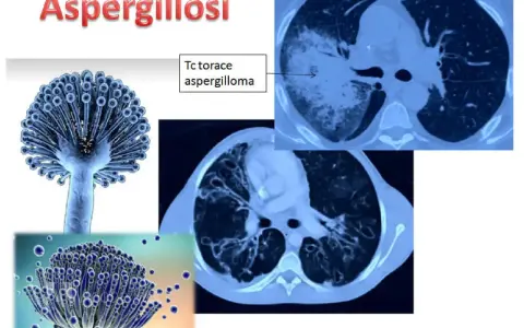 Aspergillosi: immagini di Aspergillus e TAC polmonari che mostrano un aspergilloma. L'aspergillosi è contagiosa.