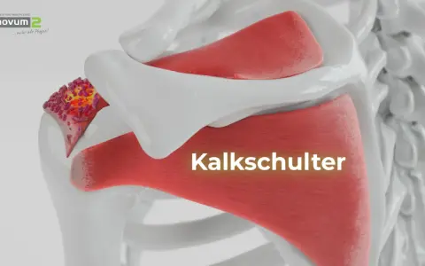 Kalkschulter: Ablagerungen im Schultergelenk. Was tun? Hier wird die Ursache der Schmerzen visualisiert.
