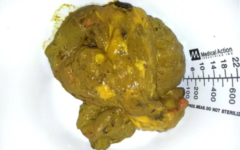 Feci oleose, di colore giallo-verdastro, con residui visibili e una consistenza untuosa. Accanto, una scala graduata.