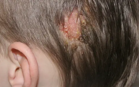 Skóra głowy z zaczerwienieniem, strupami i łuskami, wskazująca na grzybicę skóry głowy.