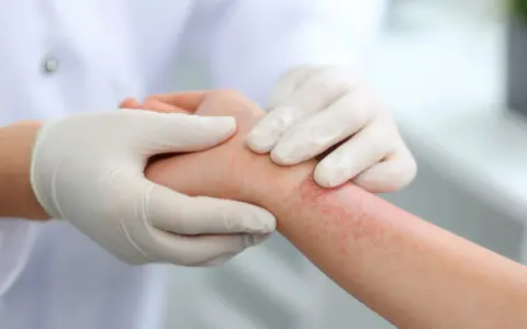 Mains gantées examinant une éruption cutanée rouge sur un poignet, suggérant un traitement eczema.