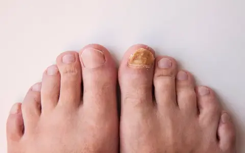 Gros plan sur des pieds, dont un ongle d'orteil atteint d'une mycose, illustrant un problème d'entretien ongles pieds.