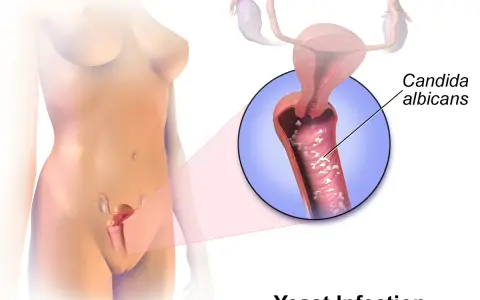 Illustration of a yeast infection in the vagina, showing Candida albicans.