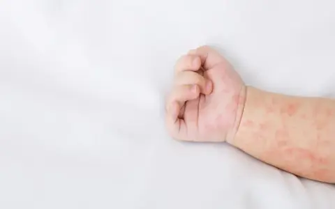 Różowa wysypka u niemowlaka na rączce. Skóra dziecka jest zaczerwieniona i pokryta drobnymi plamkami.