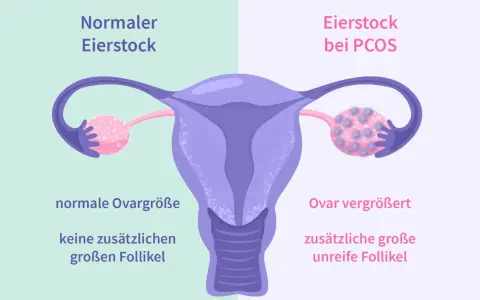 Porównanie jajnika: normalny jajnik z małą ilością pęcherzyków i jajnik przy PCOS z licznymi, niedojrzałymi pęcherzykami, co jest jednym z objawów PCOS.