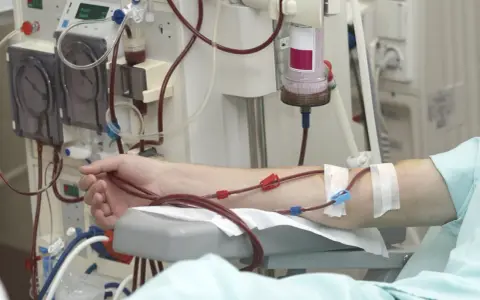 Ramię pacjenta podłączone do aparatury do dializy. Częstotliwość dializ jest kluczowa dla jego zdrowia.