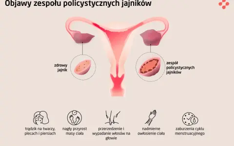 PCOS: Co to jest? Objawy, leczenie i życie z Zespołem Policystycznych Jajników