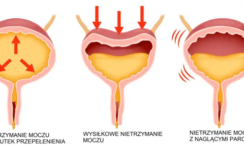 Ilustracja przedstawia trzy rodzaje nietrzymania moczu: przepełnienie, wysiłkowe i z nagłymi parciami.