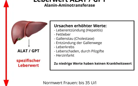 Leberwert ALAT/GPT, ein spezifischer Leberwert, kann bei Hepatitis, Fettleber oder anderen Ursachen erhöht sein. Niedrige Werte sind irrelevant.