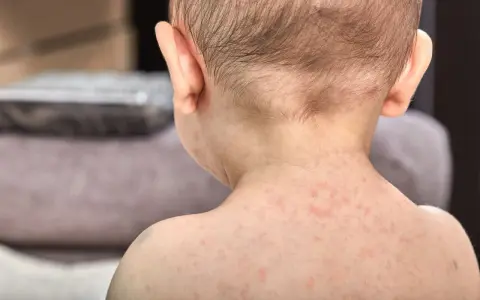Skóra dziecka pokryta drobnymi, czerwonymi krostkami. To typowa wysypka po trzydniówce, która pojawia się po ustąpieniu gorączki.