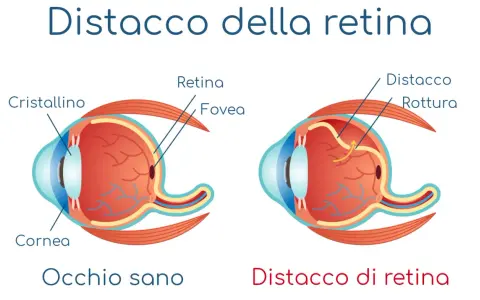 Confronto tra occhio sano e occhio con distacco della retina, mostrando la rottura e il sollevamento della retina.
