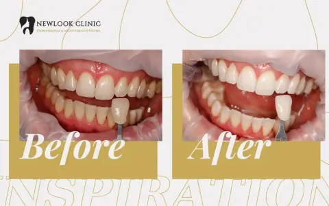 Przed i po wybielaniu zębów w New Look Clinic. Uśmiech jaśniejszy o kilka tonów!