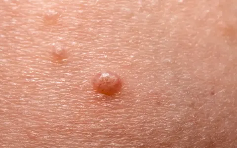 Widoczny wykwit na skórze, przypominający brodawkę, z kilkoma mniejszymi zmianami w pobliżu.