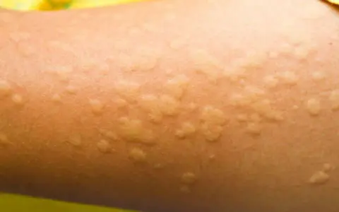 Pelle di bambino con pomfi rossastri e gonfi, tipici dell'orticaria.