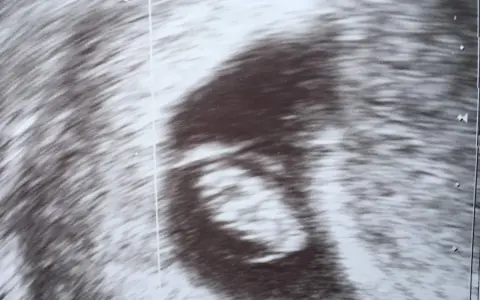 Ultraschallbild zeigt einen frühen Embryo. Die Ramzi-Methode könnte hier angewendet werden, um das Geschlecht zu erraten.